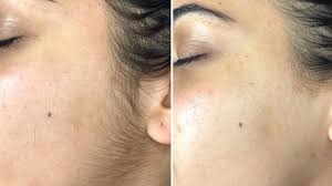 facial treatments